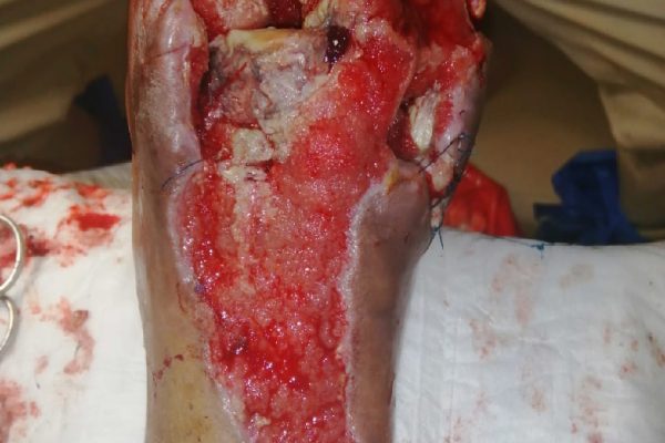 casos-exito-clinica-gala_1